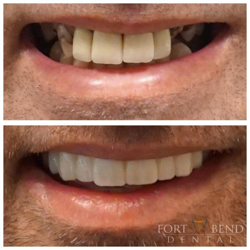 Dental Crowns before and after