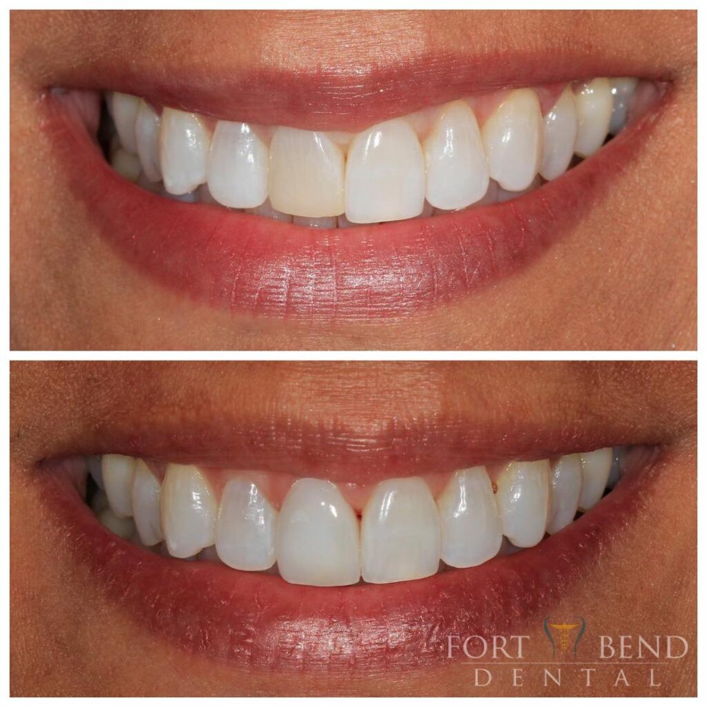 Before and after incisor crown