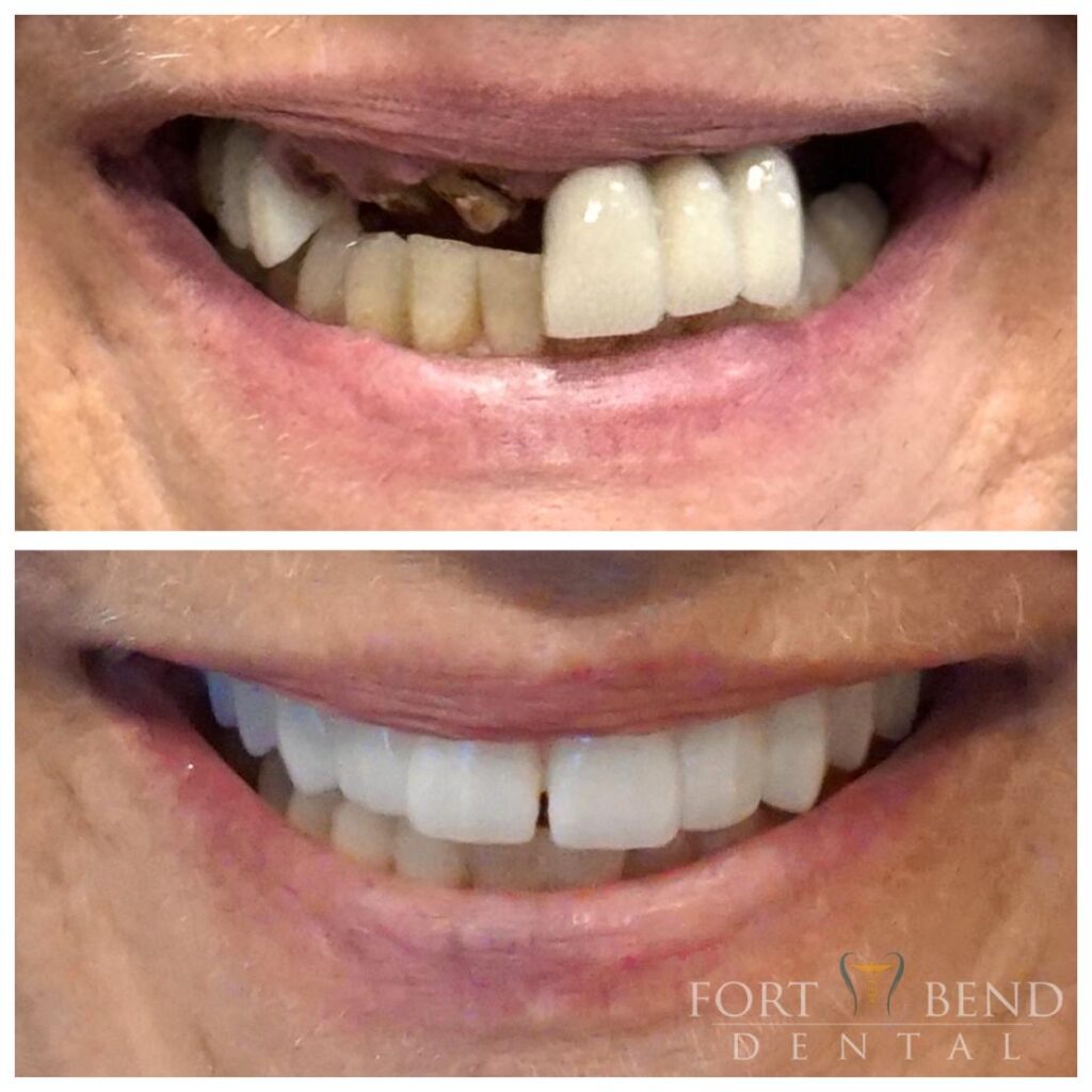 Dental Implants before and after