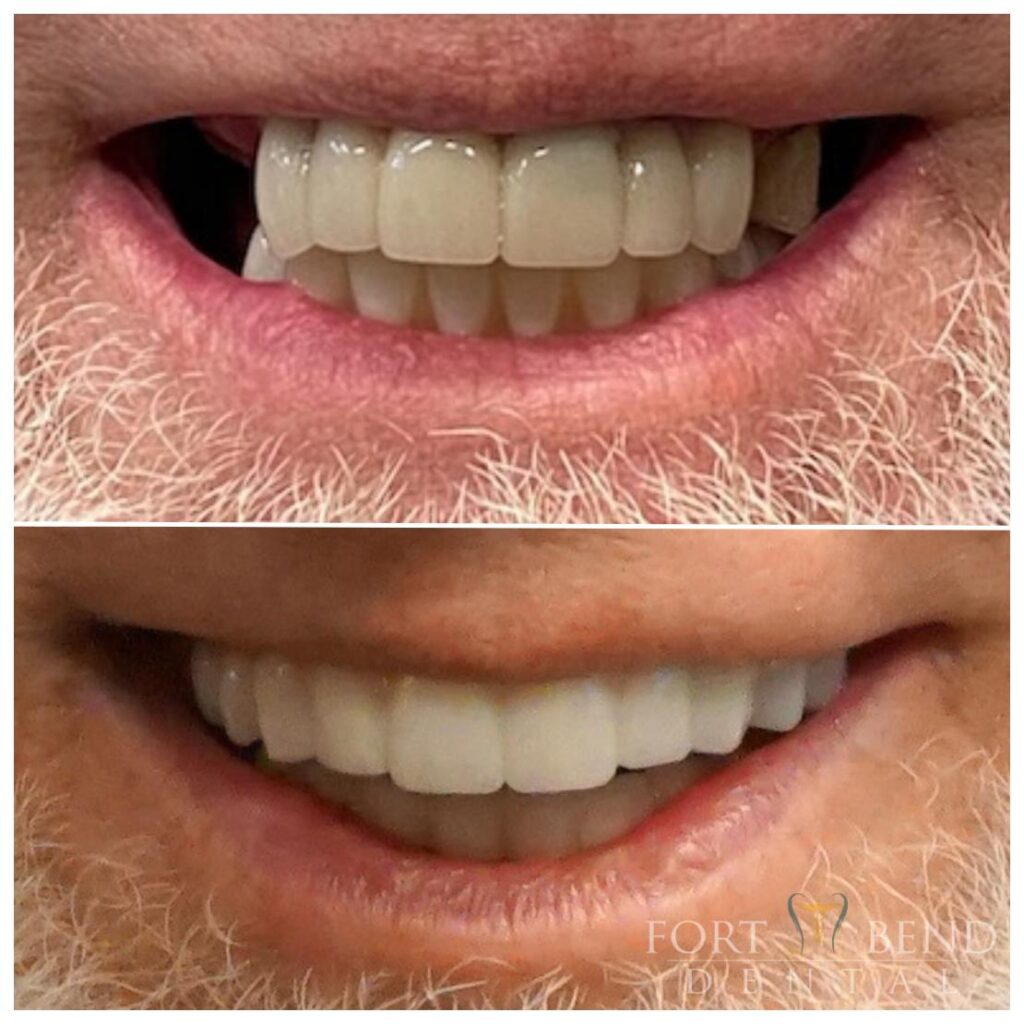 Dental Implants before and after