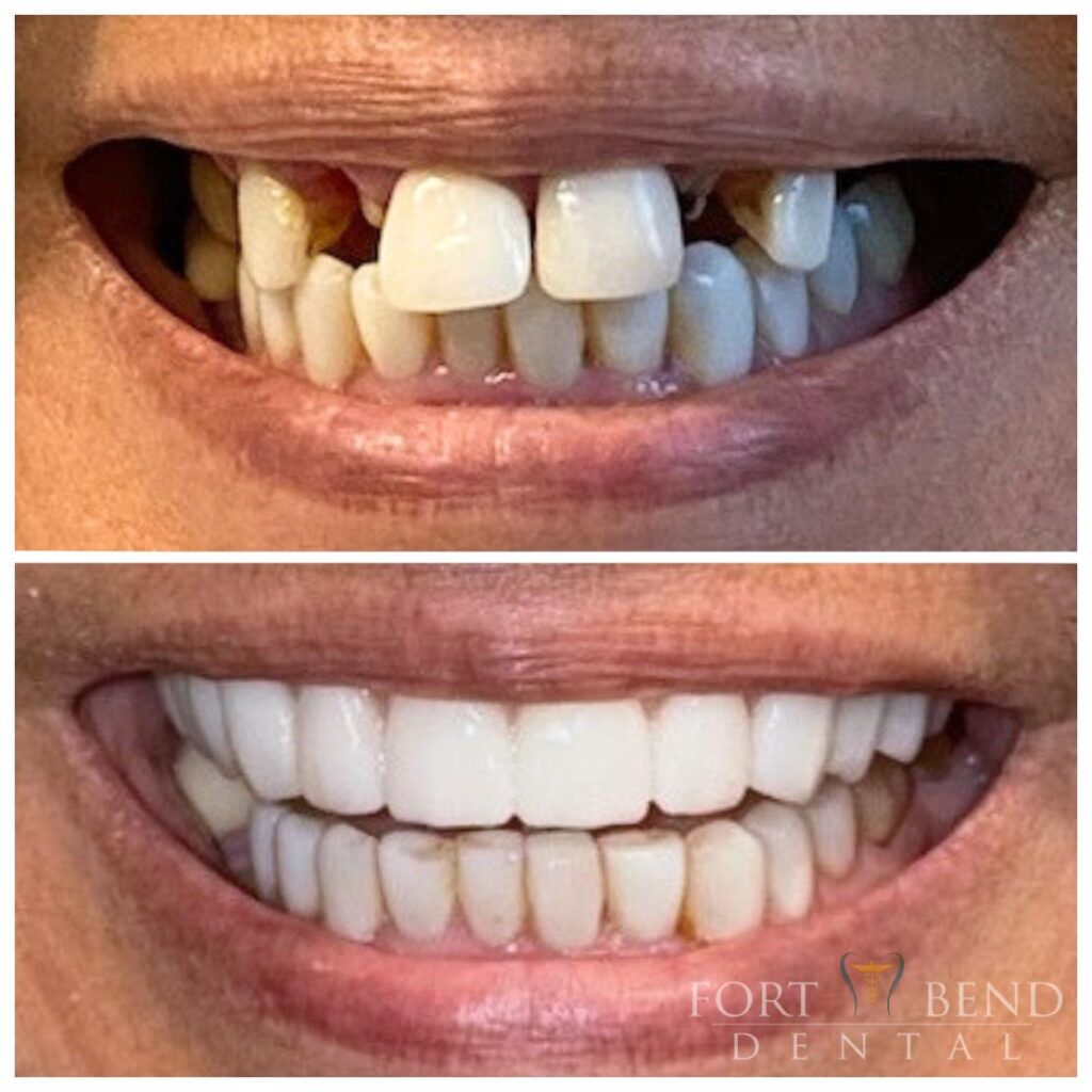 Dental Implants before and after