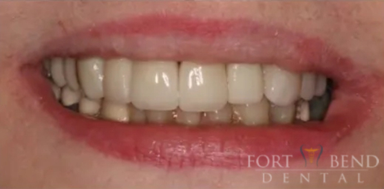 Implant & Crown Front Lateral Tooth #10, after