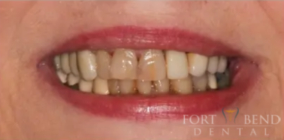 Implant & Crown Front Lateral Tooth #10, before