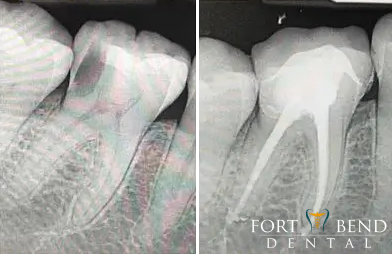root canal, tooth before and after procedure