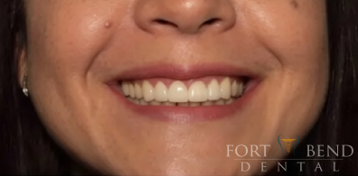 after veneers and gingivectomy correct