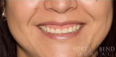 before veneers and gingivectomy correct